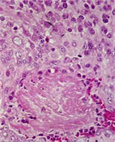 Dactinomycin