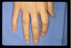 Fixed Knuckle