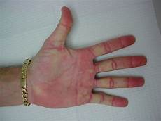 Fixed Knuckle