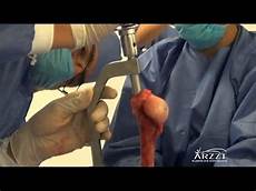 Humeral Nail