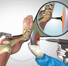 Humeral Nail