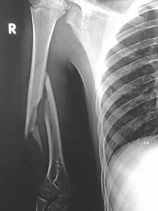 Humeral Nail