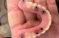 Medical Prosthesis