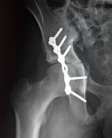 Medical Screws