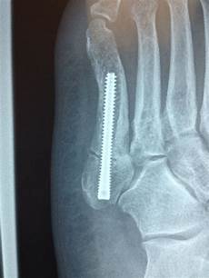 Medical Screws