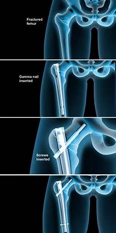 Medical Screws