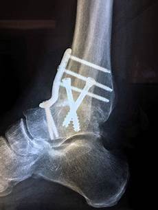 Medical Screws