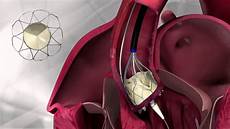 Medical Valve