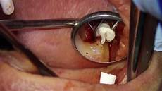 Perforated Plug