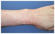 Probenecid