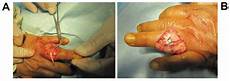 Tendon Bands