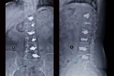 Vertebroplasty System