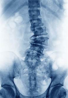 Vertebroplasty System