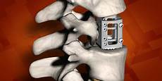 Vertebroplasty System